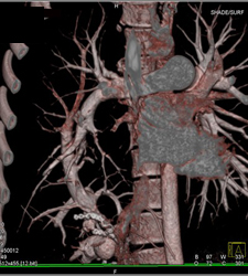 Scimitar Sign With Pulmonary Vein Draining Into the IVC - CTisus CT Scan