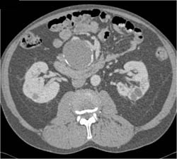 Hepatic Artery Aneurysm - CTisus CT Scan
