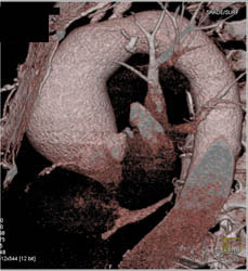 Dilated Aortic Root - CTisus CT Scan