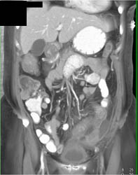 Superior Mesenteric Vein (SMV) Thrombus and Ischemic Bowel - CTisus CT Scan