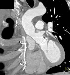 Dissection of Aortic Root - CTisus CT Scan