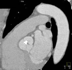 Aortic Valve With Calcification - CTisus CT Scan