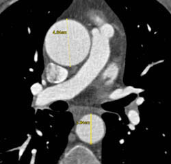 Aortic Valve Replacement With Dilated Ascending Aorta - CTisus CT Scan