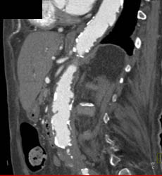 Atherosclerotic Disease With Ulcers in Abdominal Aorta - CTisus CT Scan