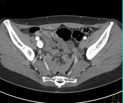 Av Shunting on the Right With Early Vein Filling - CTisus CT Scan