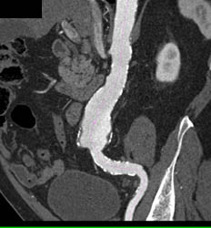 Tracking of Abdominal Aortic Aneurysm (AAA) - CTisus CT Scan
