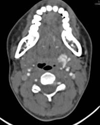 Injury to Branch of Carotid Artery With Active Extravasation - CTisus CT Scan