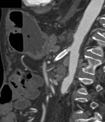 Stent in SMA - CTisus CT Scan