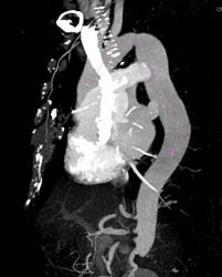 Coarctation of the Aorta - CTisus CT Scan