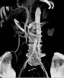 Bypass Grafts From SMA to Iliac Graft - CTisus CT Scan