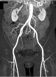 Nice Vascular Map of Gluteal Perforators - CTisus CT Scan
