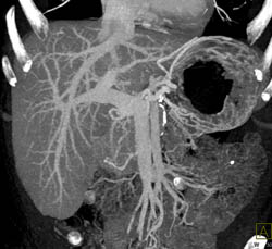Portal Hypertension - CTisus CT Scan