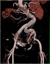 Atherosclerotic Disease Aorta With Extensive Plaque With MIP and VRT - CTisus CT Scan