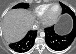 Prior Calcified Thrombus in Inferior Vena Cava (IVC) - CTisus CT Scan