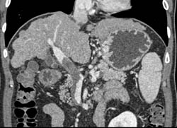 Partial Thrombosis of the Portal Vein in A Cirrhotic Patient. Clot Not Seen on MIP Images - CTisus CT Scan