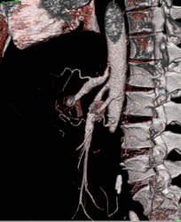 Median Arcuate Ligament Syndrome - CTisus CT Scan