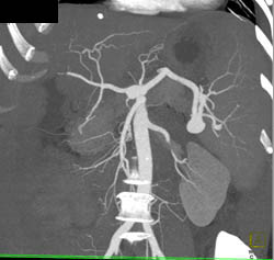 Splenic Artery Aneurysm - CTisus CT Scan