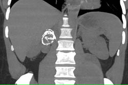Bleed in Psoas Muscle as Well as Renal Artery Aneurysm - CTisus CT Scan