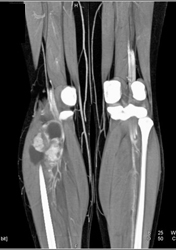 Vascular Tumor Calf Was A Synovial Cell Sarcoma - CTisus CT Scan
