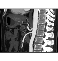 Normal Celiac/SMA - CTisus CT Scan