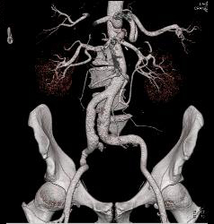 Celiac Artery Aneurysm - CTisus CT Scan