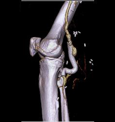 Hematoma Around Stent in Popliteal Artery. Stent Is Partially Occluded - CTisus CT Scan