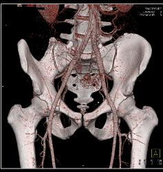 Atherosclerotic Disease Iliac Artery - CTisus CT Scan