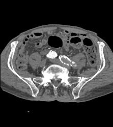 Occluded Left Iliac Artery With A Fem-fem Bypass - CTisus CT Scan