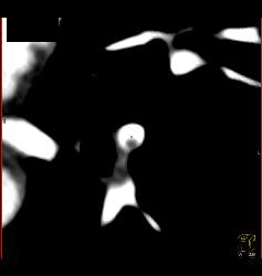 Pulmonary Embolism (PE) in Left Lobe Lung - CTisus CT Scan