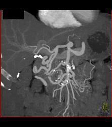 Abdominal Aortic Aneurysm (AAA) With Celiac Stenosis Due to Median Arcuate Ligament Compression. Note Post Stenotic Dilation of Celiac Artery. See Collaterals Through Gastroduodenal Artery (GDA)- Full Sequence of Images - CTisus CT Scan