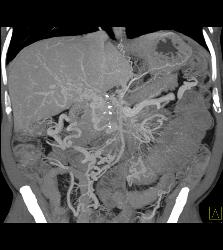 Carcinoid Tumor With Desmoplastic Reaction and Portal Vein Occlusion With Cavernous Transformation of the Portal Vein (CTPV) - CTisus CT Scan