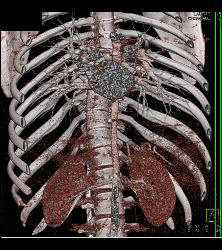 Small Caliber Aorta With Hardware Screw Abutting Aorta - CTisus CT Scan