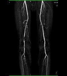 CTA Runoff in 3D With Editing and Peripheral Vascular Disease (PVD) - CTisus CT Scan