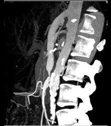 Mesenteric Bypass Graft With Stenosis- See Sequence- At Anastomosis to SMA - CTisus CT Scan