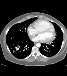 Pseudoaneurysm With Hemorrhage in Right Lower Lung - CTisus CT Scan