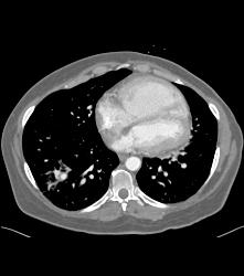 Pseudoaneurysm With Hemorrhage in Right Lower Lung - CTisus CT Scan