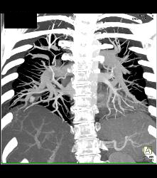 Pseudoaneurysm With Hemorrhage in Right Lower Lung - CTisus CT Scan