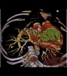 Pseudoaneurysm With Hemorrhage in Right Lower Lung - CTisus CT Scan