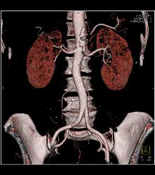 Normal Celiac Artery - CTisus CT Scan