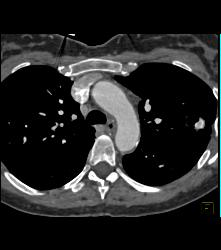 Tuberculoma in Left Upper Lung Simulates A Pulmonary Arteriovenous Malformation (PAVM) - CTisus CT Scan