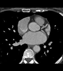 Tuberculoma in Left Upper Lung Simulates A Pulmonary Arteriovenous Malformation (PAVM) - CTisus CT Scan