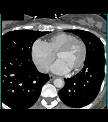 Tuberculoma in Left Upper Lung Simulates A Pulmonary Arteriovenous Malformation (PAVM) - CTisus CT Scan