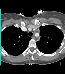 Tuberculoma in Left Upper Lung Simulates A Pulmonary Arteriovenous Malformation (PAVM) - CTisus CT Scan