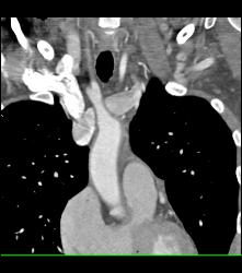 Tuberculoma in Left Upper Lung Simulates A Pulmonary Arteriovenous Malformation (PAVM) - CTisus CT Scan