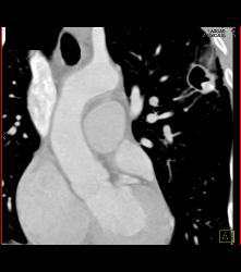 Tuberculoma in Left Upper Lung Simulates A Pulmonary Arteriovenous Malformation (PAVM) - CTisus CT Scan