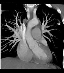 Tuberculoma in Left Upper Lung Simulates A Pulmonary Arteriovenous Malformation (PAVM) - CTisus CT Scan