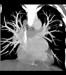 Tuberculoma in Left Upper Lung Simulates A Pulmonary Arteriovenous Malformation (PAVM) - CTisus CT Scan