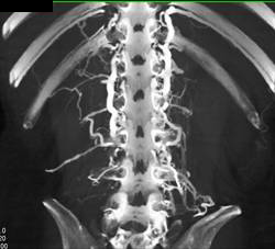 Dilated Paraspinal Vessels - CTisus CT Scan