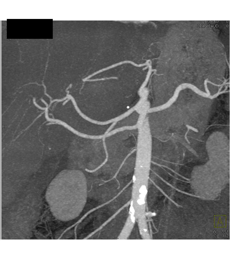 Accessory Right Hepatic Artery off the SMA - CTisus CT Scan