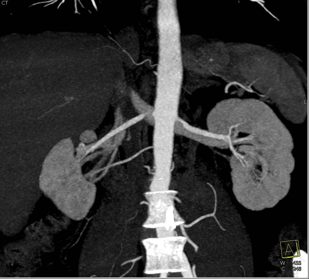 Renal Artery Stenosis - CTisus CT Scan